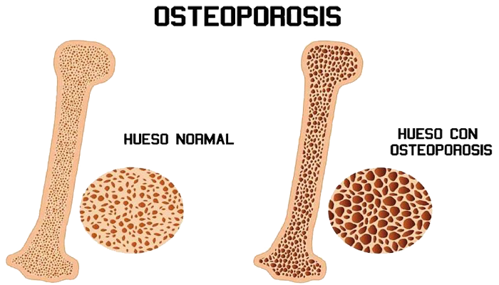 Hueso Osteoporosis Osteolisis