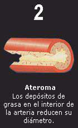 Paso 2 Acumulacion Colesterol Arteria Ateroma Depositos