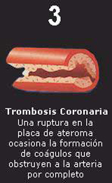 Paso 3 Acumulacion Colesterol Arteria Trombosis Coronaria Coagulos Obstruccion