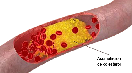 Acumulacion Colesterol Arteria