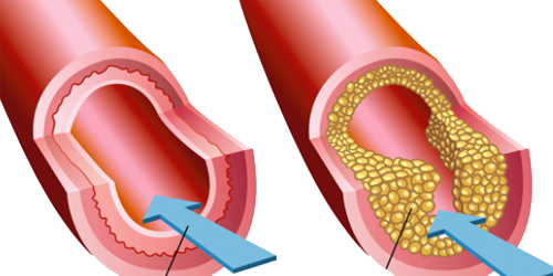 Acumulacion Colesterol Arteria Oclusion Obstruccion
