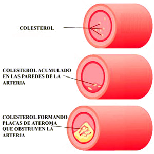 Colesterol Arteria Acumulacion Paredes Placas Ateroma Obstruccion