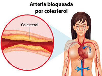 Colesterol Arteria Bloqueada