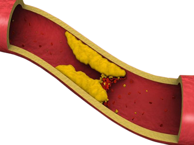 Colesterol Arteria Acumulacion Paredes Placas Ateroma Obstruccion Coagulos