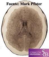 Foco Hamer Cerebro Tac Tomografia Axial Computarizada