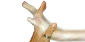 Alucinaciones Sensoriales Constelacion Cerebral Postsensorial
