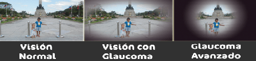 Ojo Glaucoma Avanzado Cuerpo Vitreo Vision