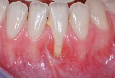 Encia Gingiva Diente Expuesto Mucosa Boca Esmalte Dental Ectodermo