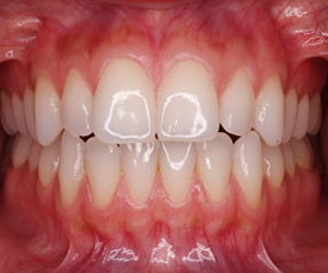 Encias Gingivas Dientes Boca Esmalte Dental Ectodermo