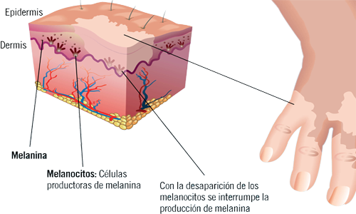 Vitiligo Piel Despigmentacion Melanocitos Melanina Ectodermo