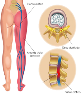 Cadera Pierna Columna Vertebral Nervio Ciatico Dolor Ectodermo