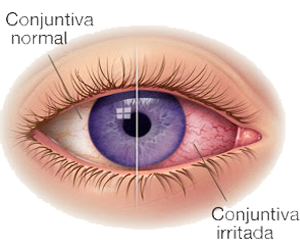 Ojo Parpado Pupila Iris Esclerotica Conjuntiva Normal Irritada