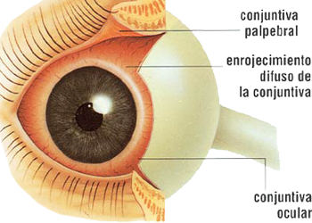 Ojo Parpado Conjuntiva Palpebral Ocular Enrojecimiento