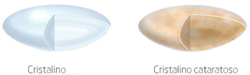 Ojo Cristalino Cataratas
