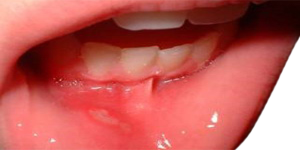 Labio Encia Boca Mucosa Irritacion Inflamacion
