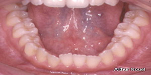 Boca Lengua Recubrimiento Mucosa Epitelio Encias
