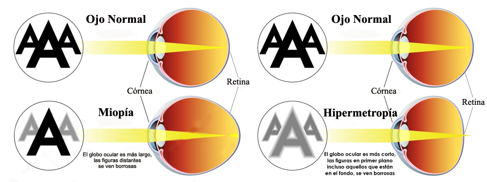 Retinas Miopia Hipermetropia Ojo Normal Globo Ocular Ectodermo