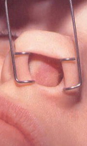 Cavidad Fosa Nasal Nariz