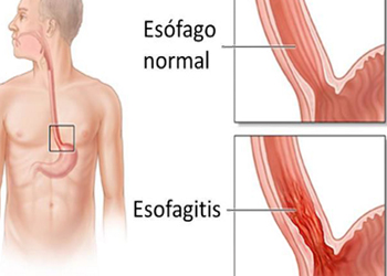 Esofago Normal Esofagitis