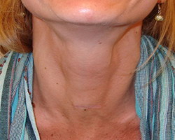 Glandula Tiroides Endodermo Cuello ubicacion