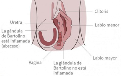Glandula Bartholin Inflamacion Bartholinitis Vulva