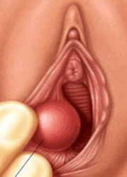 Glandula Bartholin Inflamacion Bartholinitis Labio Vaginal