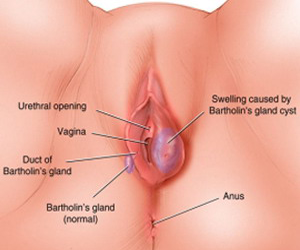 Glandula Bartholin Inflamacion Bartholinitis Hinchazon