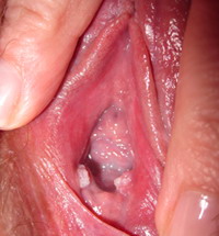 Vulva Abierta Dedos Labios Glandulas Bartholin Mucosa