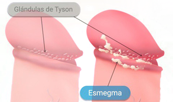 Pene Glandulas Tyson Esmegma Glande
