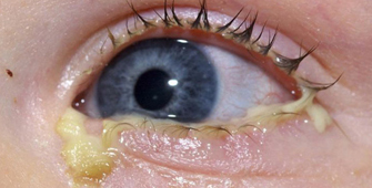 Ojo Lagrimas Purulentas Glandula Lagrimal Endodermo