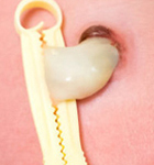 Ombligo Cordon Umbilical Cortado Endodermo