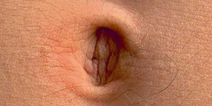 Ombligo Externo Adulto Endodermo