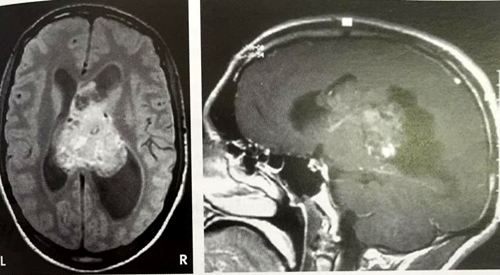Imagen Endodermo Plexos Coroideos Ventriculos Cerebrales