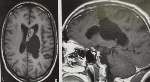 Imagen Endodermo Plexos Coroideos Ventriculos Cerebro
