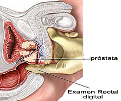Prostata Examen Rectal Digital Tacto
