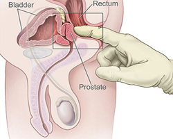Prostata Examen Rectal Digital Tacto Anal