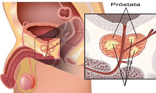 Prostata Tumor Proliferacion Celular Endodermo