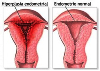 Endometrio Normal Utero Hiperplasia Endometrial