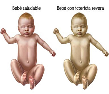 Bebe Saludable Piel Amarilla Nacimiento Ictericia Neonatal Severa