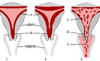 Desprendimiento Tejido Endometrio Mensatruacion Sangrado Vaginal