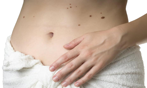 Piel Mlanomas Lunares Dermis Mesodermo Antiguo