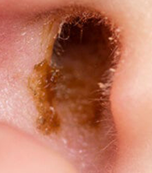 Glandulas Ceruminosas Cerumen Oido