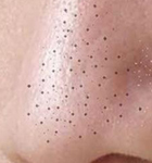 Nariz Puntos Negros Glandulas Sebaceas Mesodermp Antiguo