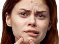 Mujer Espinilla Acne Grano Barro Cara