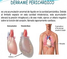 Pericardio Mesodermo Antiguo Derrame