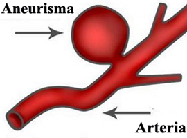 Arterias Aneurismas Sangre Mesodermo Nuevo