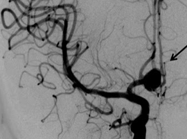 Arterias Aneurismas Cerebro Sangre Mesodermo Nuevo