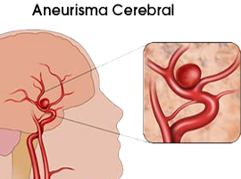 Arteria Aneurisma Cerebral Sangre Mesodermo Nuevo
