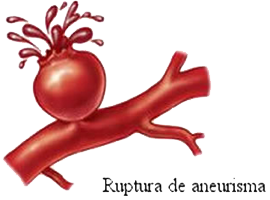 Arteria Ruptura Aneurisma Sangre Mesodermo Nuevo