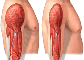 Brazo Musculos Atrofia Perdida Masa Muscular